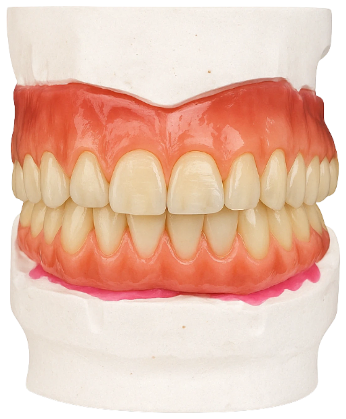 Modelo de prótese dentária completa produzido pelo LV Laboratório